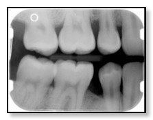 Example xray image taken during annual exam cleaning and xrays